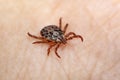 Borrelia Infected Tick Insect Crawling on Skin. Dermacentor reticulatus. Encephalitis Virus or Lyme Borrelia Disease Infectious Royalty Free Stock Photo