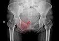 Hip x-ray Fracture right superior pubic ramus.Normal both hips Royalty Free Stock Photo