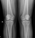 Both Knee X-Ray: Diagnostic Evaluation of Bone Structure