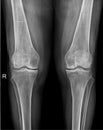 Both Knee X-Ray: Diagnostic Evaluation of Bone Structure