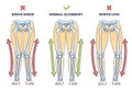 Bowed legs syndrome with normal and knock legs comparison outline diagram
