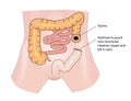 Bowel cancer and stoma