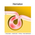 Bowel Obstruction. Hernia