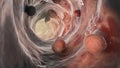 Bowel polyps, colorectal polyps, 3D illustration