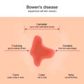 Bowen`s disease. squamous cell skin cancer. Royalty Free Stock Photo