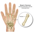 Boxer`s bone hand fracture medical vector illustration Royalty Free Stock Photo