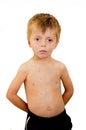 Boy with chicken pox