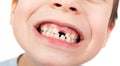 Boy face closeup with a lost tooth