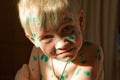 Boy with green dots of chickenpox