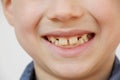 Boy, kid smiling with open mouth, close-up of a childÃ¢â¬â¢s mouth, concept of child skin care, emotional development of elementary Royalty Free Stock Photo