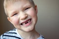 Boy missing milk teeth