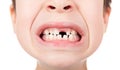 Boy portrait with a lost tooth Royalty Free Stock Photo