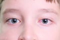 A boy with red irritated eye after long time using gadgets, tired eyes concept Royalty Free Stock Photo