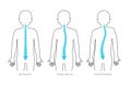 Scoliosis flat vector illustration