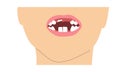 A boy smile missing tooth due to change of milk teeth. Simple minimalistic illustration of baby mouth with incomplete