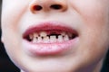 Boy smiling toothless Royalty Free Stock Photo