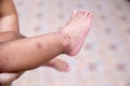 Boy with symptoms hand, foot and mouth disease . children ` HFMD ` with disease .Mouth Foot and Mouth Disease caused by a strain Royalty Free Stock Photo