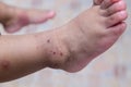 Boy with symptoms hand, foot and mouth disease . children ` HFMD ` with disease .Mouth Foot and Mouth Disease caused by a strain Royalty Free Stock Photo