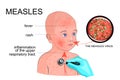 The boy with the symptoms of rubella or measles
