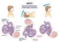 BPPV or benign paroxysmal positional vertigo syndrome outline diagram Royalty Free Stock Photo