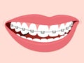 Braces Corrective Orthodontics Royalty Free Stock Photo