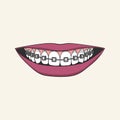 Braces Corrective Orthodontics. Smiling female mouth with healthy teeth and braces. Vector illustration.