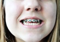 Braces on crooked teeth Royalty Free Stock Photo