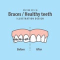 Braces-Healthy teeth illustration vector on blue background. Den