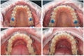 before and after braces are installed. Upper and lower jaw. Correction of teeth using braces