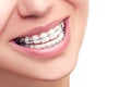 Braces. Orthodontic Dental Care Concept. Royalty Free Stock Photo