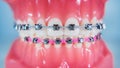 The braces are placed on the teeth in the artificial jaw. Macro photography Royalty Free Stock Photo