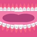 Braces Teeth. Dental Care Background. Orthodontic Treatment. Cartoon Opening Mouth. Royalty Free Stock Photo