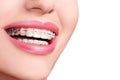 Braces on Teeth. Dental Braces Smile. Orthodontic Treatment. Royalty Free Stock Photo