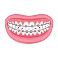 Braces on teeth. pink lips white teeth.