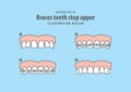 Braces teeth step upper illustration vector on blue background.