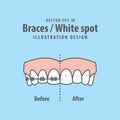 Braces-White spot illustration vector on blue background. Dental