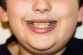 Braces and white teeth of smiling boy brackets medicine dantist