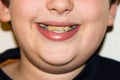 Braces and white teeth of smiling boy medical care Royalty Free Stock Photo