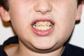 Braces and white teeth of smiling boy medical care Royalty Free Stock Photo