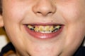 Braces and white teeth of smiling boy medical care Royalty Free Stock Photo