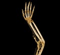 Brachial Arteries of the arm with Upper extremity Bone 3D rendering from CT Scanner