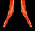 Brachial Arteries of the arm with Upper extremity Bone 3D rendering from CT Scanner