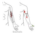 Brachialis trigger points and upper arm pain