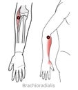 Brachioradialis Trigger points can cause pain down the thumb side of arm from elbow to thumb.