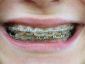 Brackets on teeth Royalty Free Stock Photo