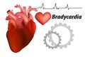 Bradycardia.  Sinus bradycardia and Sick sinus Royalty Free Stock Photo