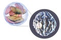 Brain abscess caused by parasitic protozoan Toxoplasma gondii