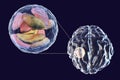 Brain abscess caused by parasitic protozoan Toxoplasma gondii