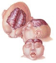 Brain - Anencephaly -Top, Front and Side Views