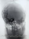 Brain angiography, arteriography Royalty Free Stock Photo